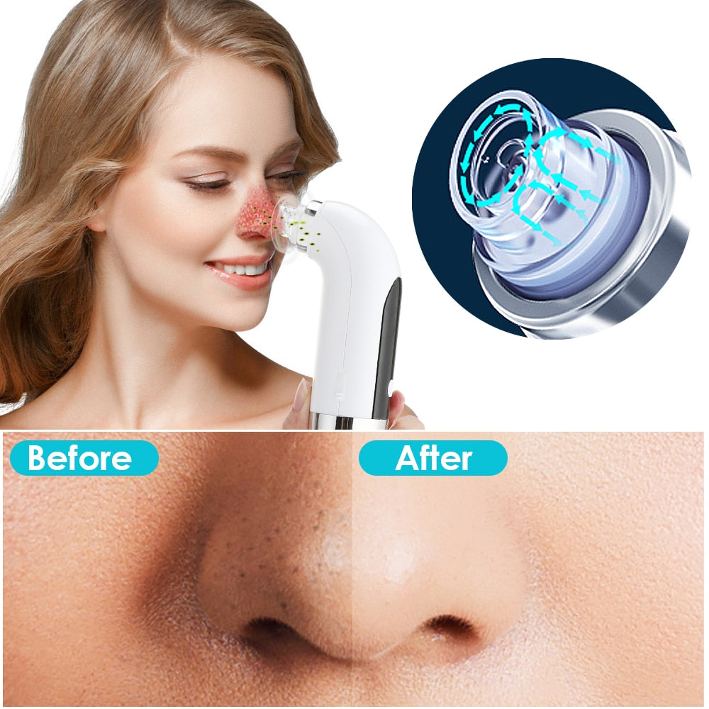 Blackhead Vacuum Remover